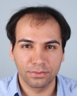 Before Hair Transplant &nbsp;Front